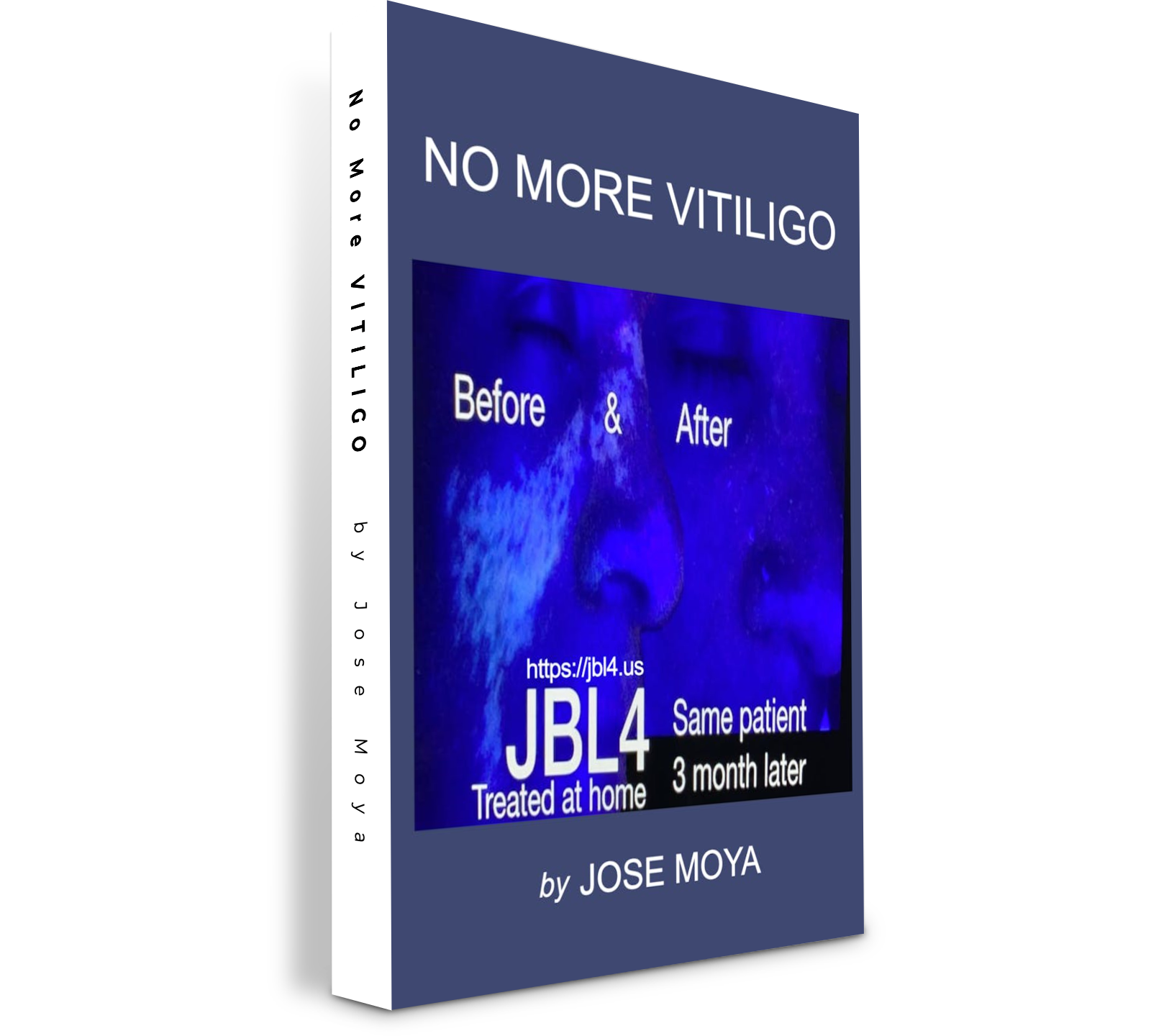 No More Vitiligo
